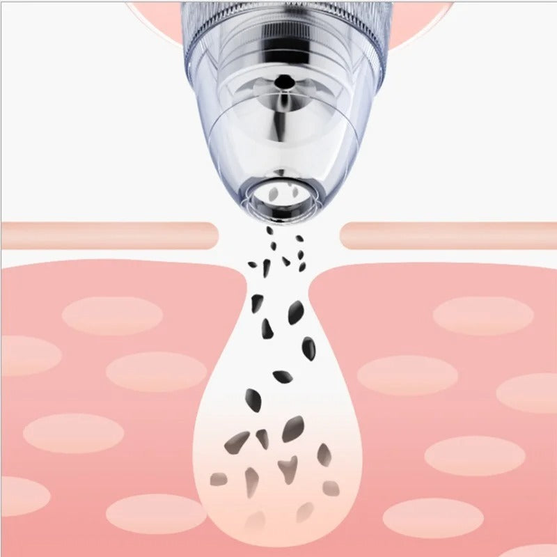 Extractor de puntos negros & acne